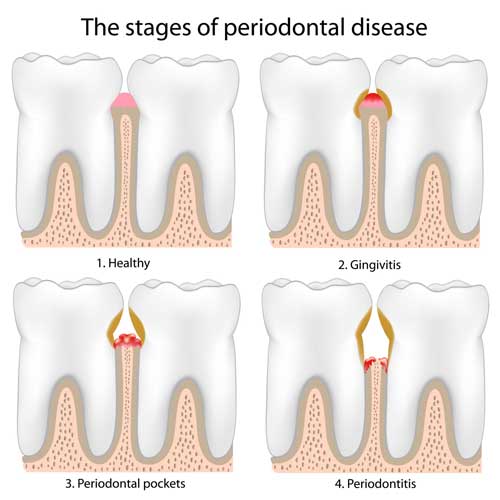 Stadien der Parodontitis: 1. Gesund, 2. Zahnfleischentzündung, 3. Tiefe Zahnfleischtaschen 4. Knochen ist angegriffen 